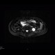 Chronic pancreatitis, dilated pancreatic duct: MRI - Magnetic Resonance Imaging